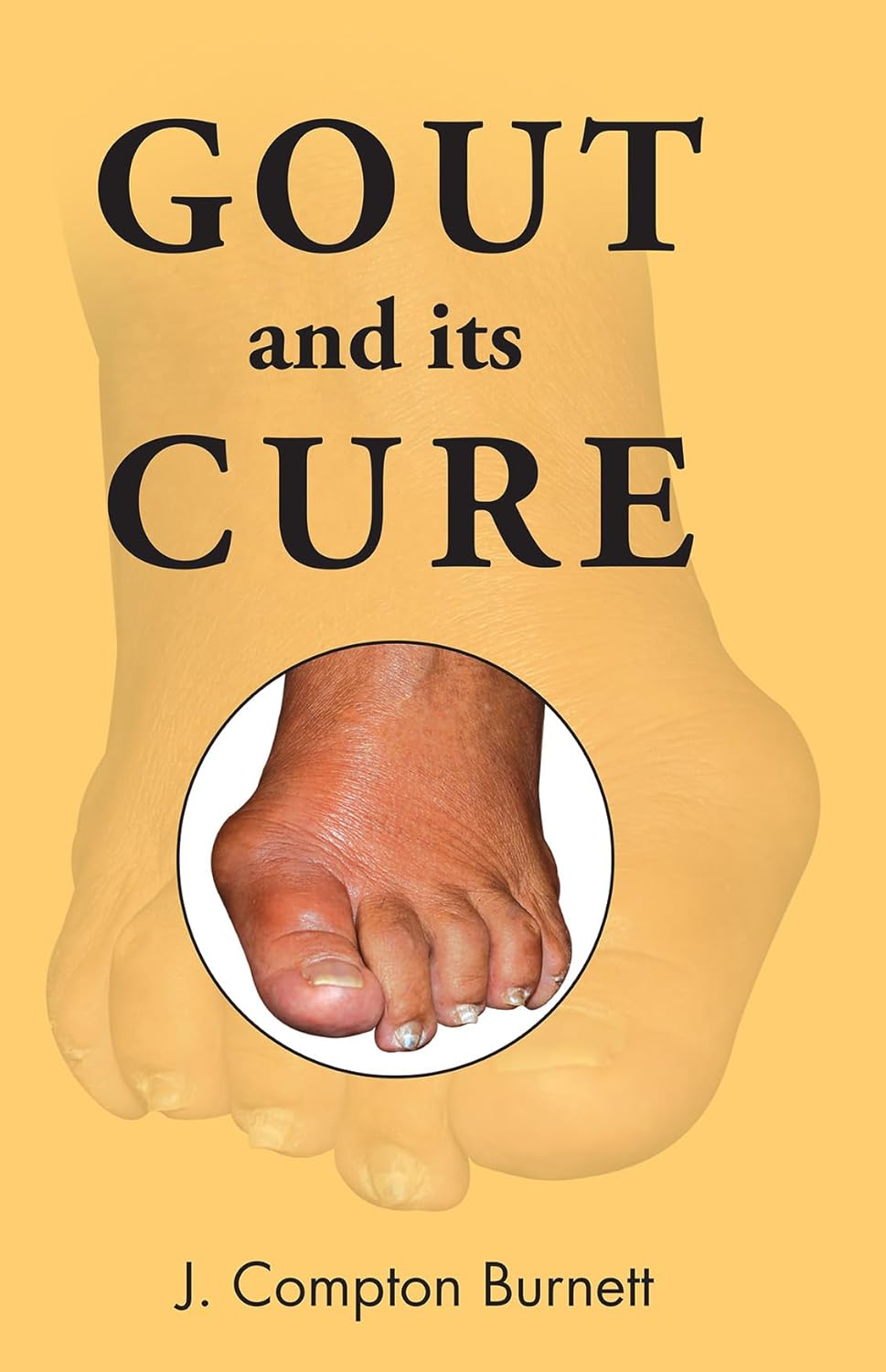 Gout &amp; Its Cure
